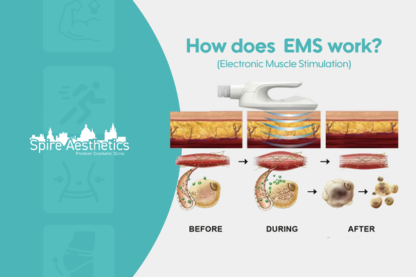 EMS treatment for post pregnancy weight loss treatment Huddersfield