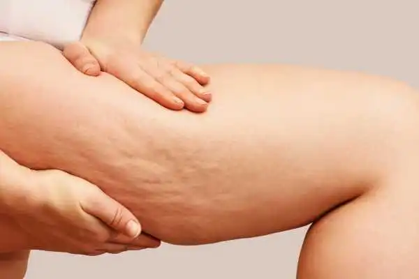 Image of woman showing leg with cellulite Huddersfield