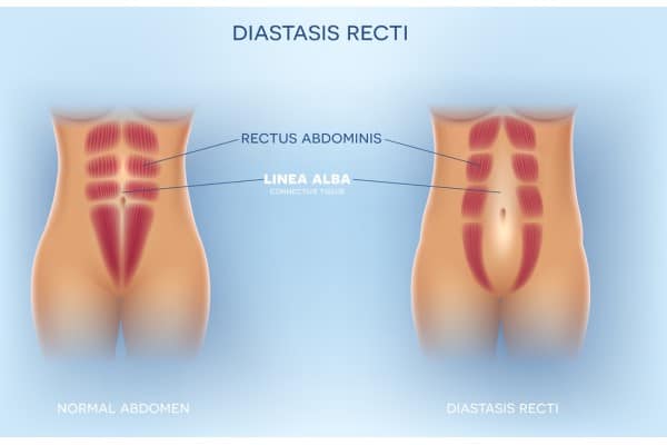 What Non-Surgical Options Are Available for Diastasis Recti Huddersfield?