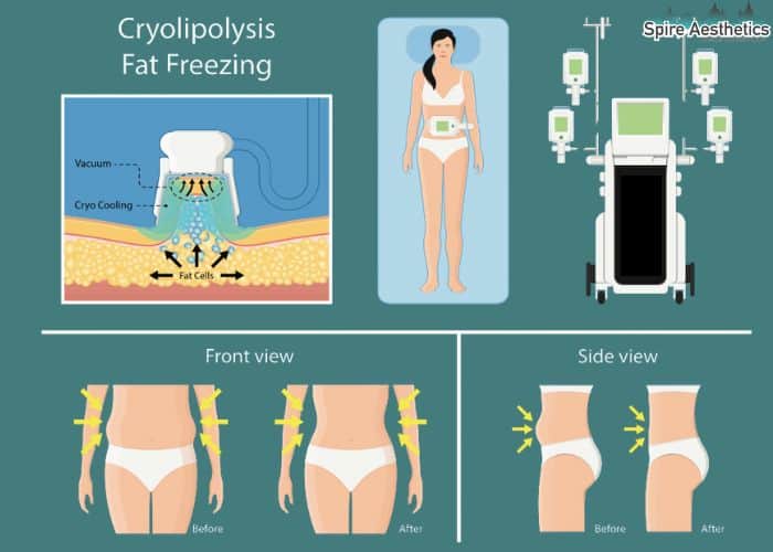 Image of diet and fat freezing combined for best results for Spire Aesthetics Huddersfield