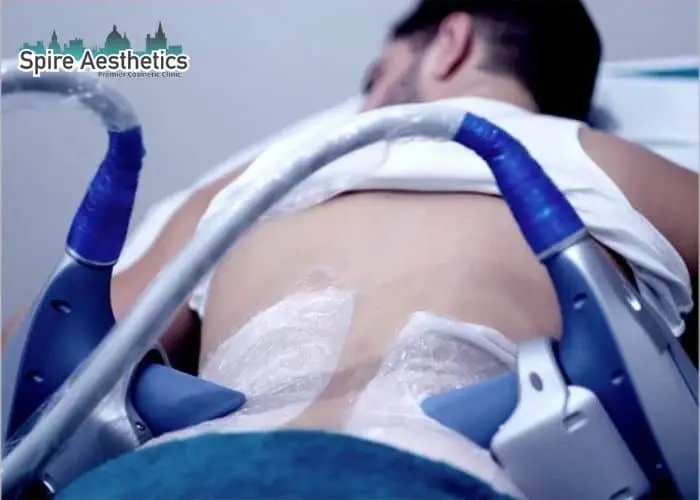 Man having fat freezing treatment done on love handles before a competitions Huddersfield to create a sculpted look.