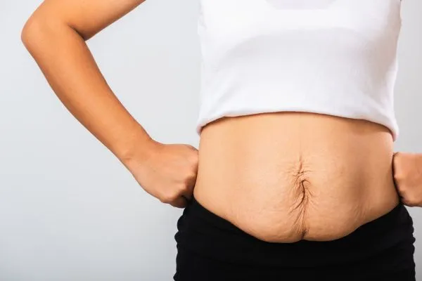 Image of a woman's stomach after weight loss with sagging skin following a gastric band Huddersfield