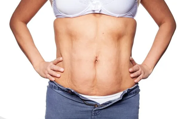 sagging skin on woman's stomach after weight loss injections Huddersfield
