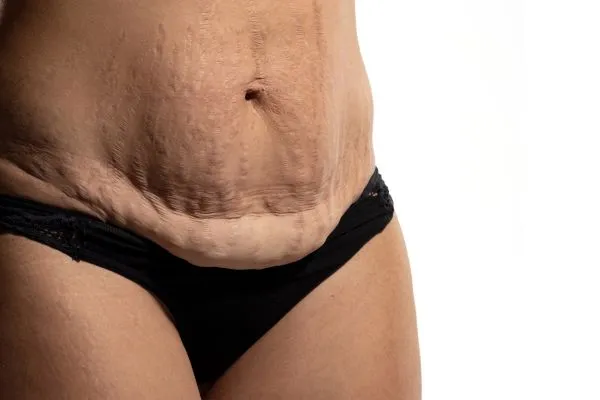 Image of womans stomach after weight loss injections Huddersfield showing saggy skin
