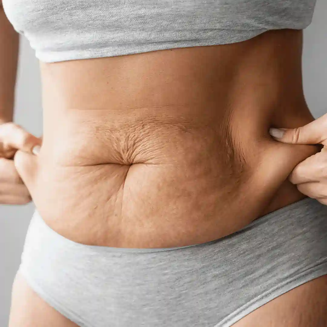 Is It Normal to Have Loose Skin After Pregnancy Huddersfield?