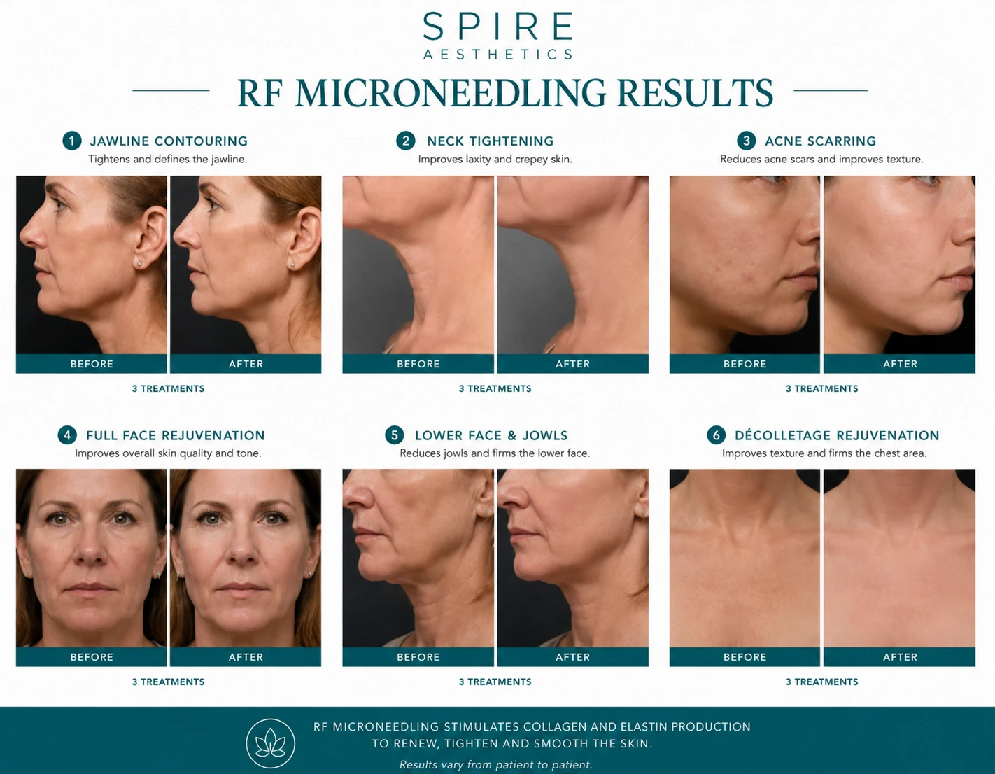 RF Microneedling Skin tightening Huddersfield results