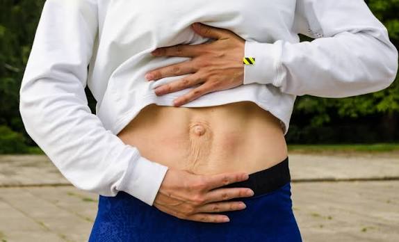 When Could Diastasis Recti Be the Missing Piece of the Puzzle Huddersfield?