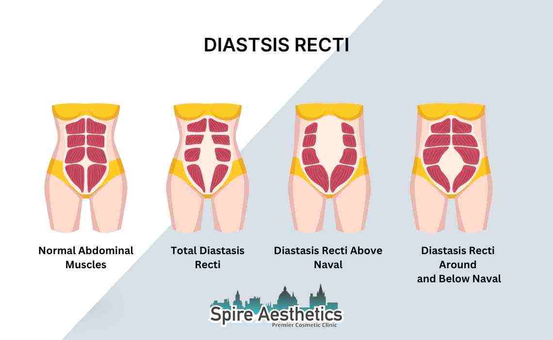 Is Non-Surgical Diastasis Recti Treatment Right for You? Common Concerns Answered Huddersfield